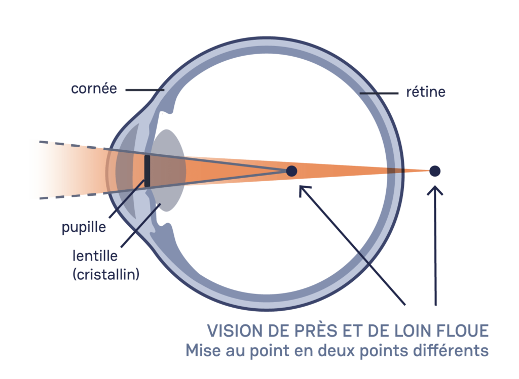 schéma œil astigmatisme