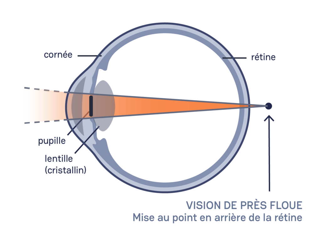 schéma d'un œil avec trouble de l'hypermétropie, vu en coupe