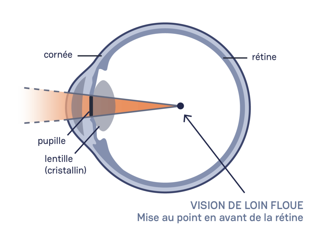 schéma d'un œil avec trouble de la myopie, vu en coupe