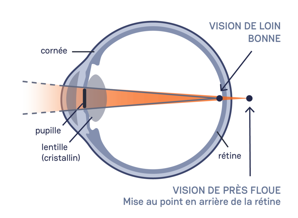 schéma d'un œil avec trouble de la presbytie, vu en coupe